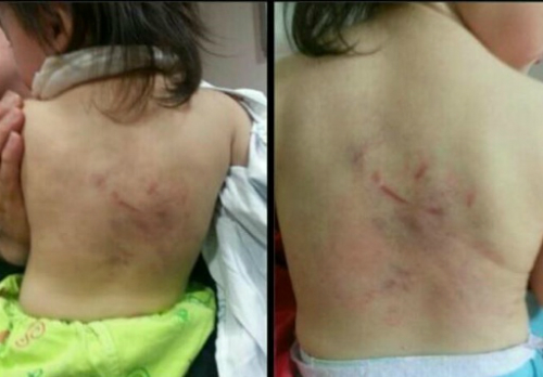 전치 2주의 상해를 입은 18개월 영아 ⓒ트위터