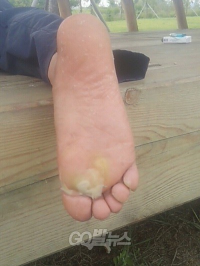 하루 평균 28km를 걷는  아버지와 딸의 발은 물집투성이다. 발이 부은 이호진 씨가 신발은 벗고 휴식을 취하고있다. 오른쪽 발에 큰 물집이 잡혀있다. 그러나 왼쪽발은 상태가 더 심각한 상태다. ⓒ ‘go발뉴스’