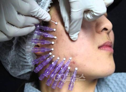 고발뉴스는 지난 10월 31일, 복수의 최순실씨 주변 측근 인터뷰를 인용해 ‘최씨가 6개월에 한번 정도 정기적으로 의사를 대동해 청와대에 들어갔으며, 일반 보톡스 시술 보다 시간이 오래 걸리는 일명 매선침 피부 리프팅 시술을 해줬다’는 내용을 단독 보도한 바 있다. ⓒ go발뉴스